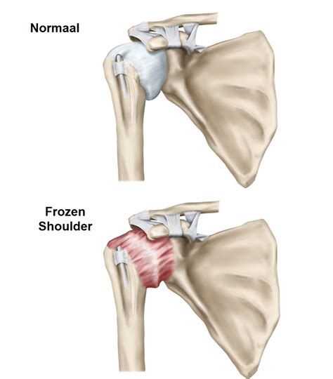 Overzicht van de verschillende fasen van een frozen shoulder