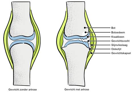 Schematische weergave van een gezond kniegewricht versus een kniegewricht met artrose.