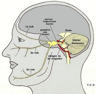 Schema van de aangezichtszenuw (nervus facialis) en zijn vertakkingen naar de gezichtsspieren