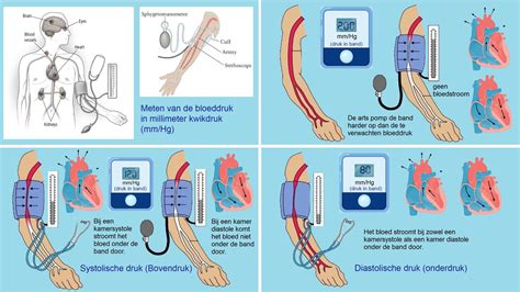 Illustratie van een bloeddrukmeter die de bloeddruk meet tijdens het oppompen van de manchet