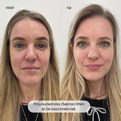 Russische Popeye voor en na injecties