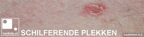 Illustratie van huidschimmel op de huid met ringvormige plekken