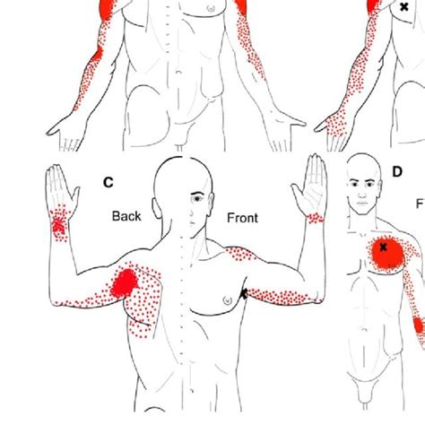 Illustratie van referred pain vanuit de biceps