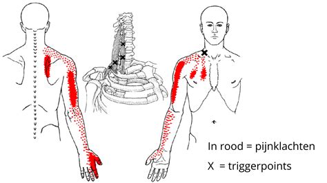 Schema van mogelijke pijnprojecties van triggerpoints in de triceps