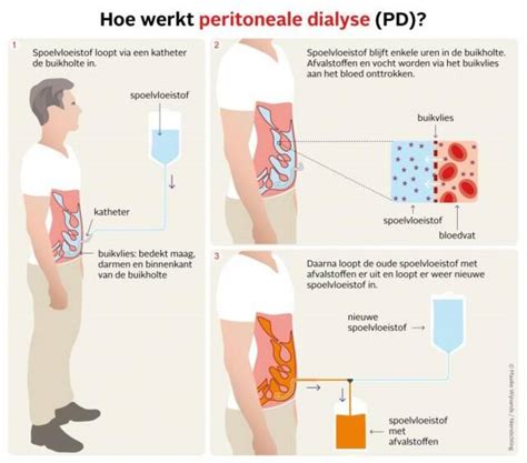 Schematische weergave van de peritoneale dialyse