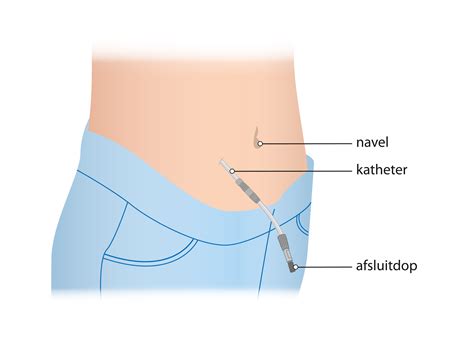 Medische illustratie van een peritoneale dialysekatheter