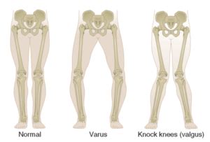 Visualisatie van knie valgus (knieën naar binnen) versus correcte kniepositie tijdens een squat.