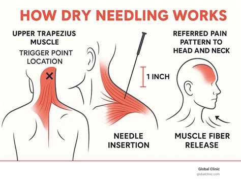 Animatie die het proces van dry needling illustreert, inclusief de 'twitch'-reactie