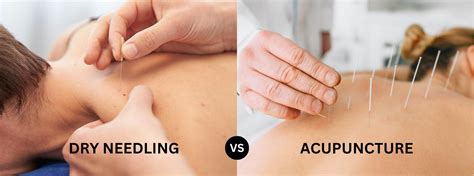 Vergelijkende infographic van dry needling en acupunctuur
