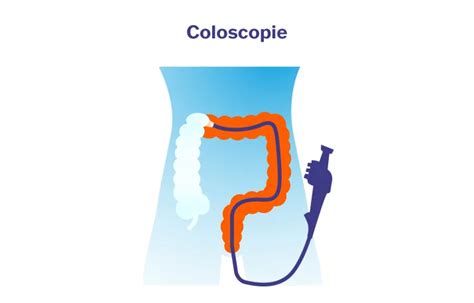 Schema van een coloscopie