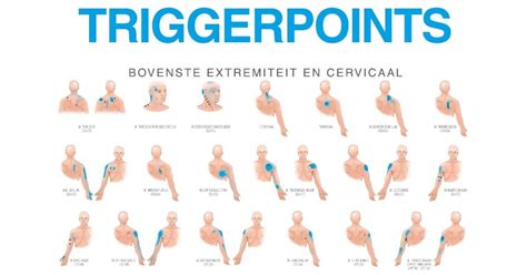 Illustratie die de locatie van triggerpoints in de biceps femoris en de bijbehorende uitstralende pijn toont.