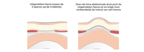 Vergelijking van een gezonde buikwand en een buikwand met diastase