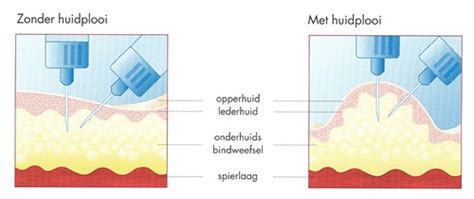 Illustratie van hoe een huidplooi correct gemeten wordt met een huidplooimeter