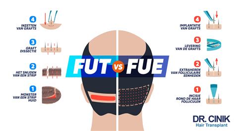 Illustratie van de DHI haartransplantatie techniek met de Choi Pen