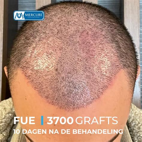 Schema van de stappen van een DHI haartransplantatie