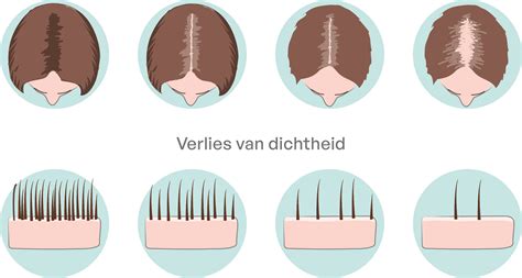 Grafiek die de haargroei na een DHI transplantatie toont over tijd