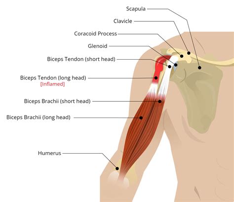 Triceps tendinopathie symptomen