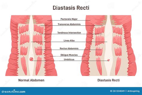 Illustratie van rectus diastase