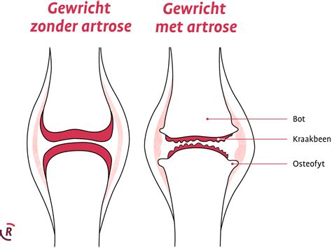 Mens met artrose die fietst
