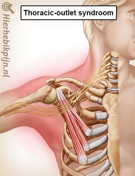 Grafische weergave van het Thoracic Outlet Syndroom