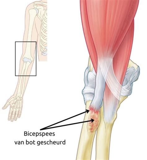 Illustratie van het Popeye-sign bij een bicepsruptuur