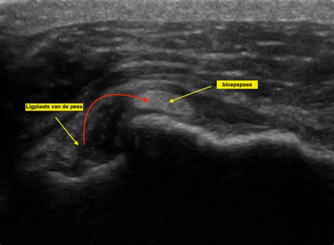 Echografie van een gezonde bicepspees versus een ontstoken bicepspees