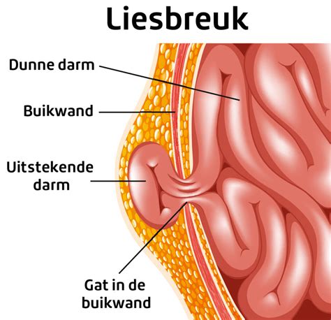 Illustratie van een liesbreuk