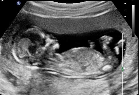 Baby op echo