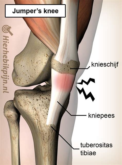 Schema van de oorzaken van een jumpers knee