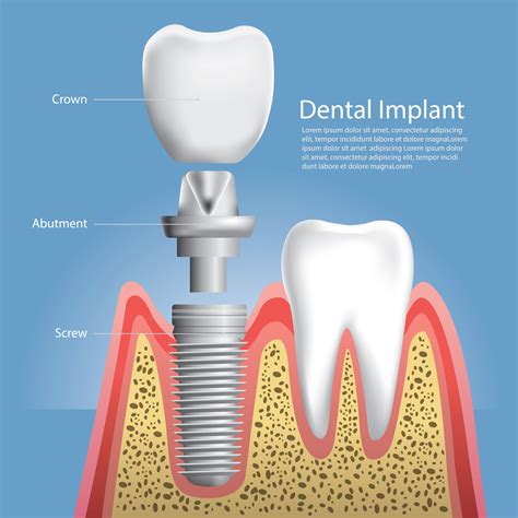 Implantaten in de mond