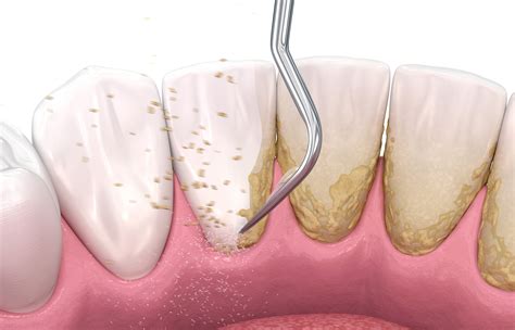 Grafiek die de reductie van tandplak en gingivitis vergelijkt met en zonder DZA-technologie