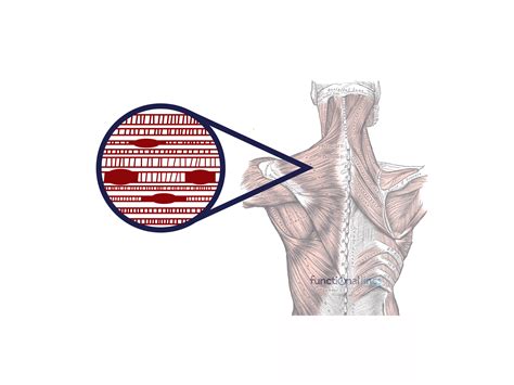 Dry needling triggerpoints