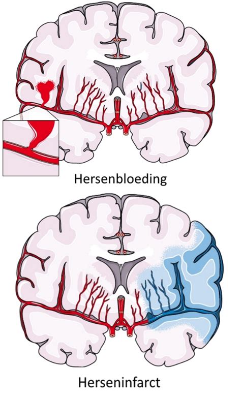 Illustratie van een herseninfarct