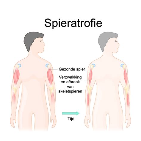 Illustratie van spieratrofie bij sarcopenie
