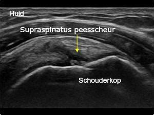 Musculoskeletale echografie van de schouder